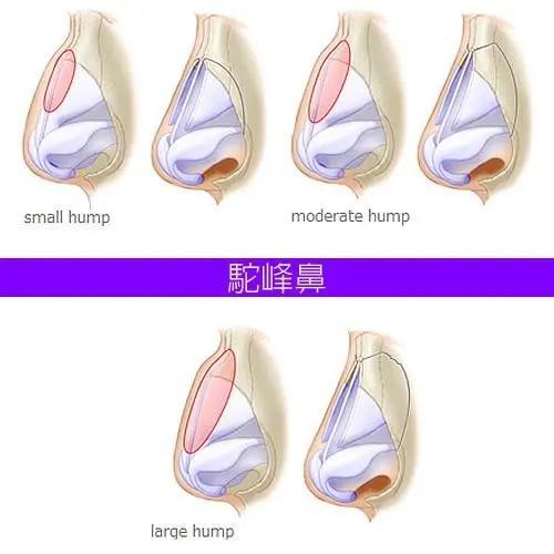 什么是驼峰鼻 驼峰鼻怎么矫正效果好 腾讯网