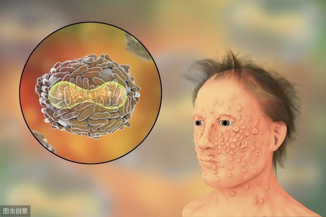 天花是人类历史上第一个被消灭的病毒