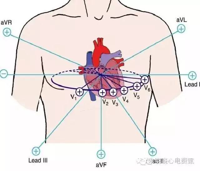 常規心電圖採用Ⅰ,Ⅱ,Ⅲ,avr,avl,avf,v1—v6等12個導聯.