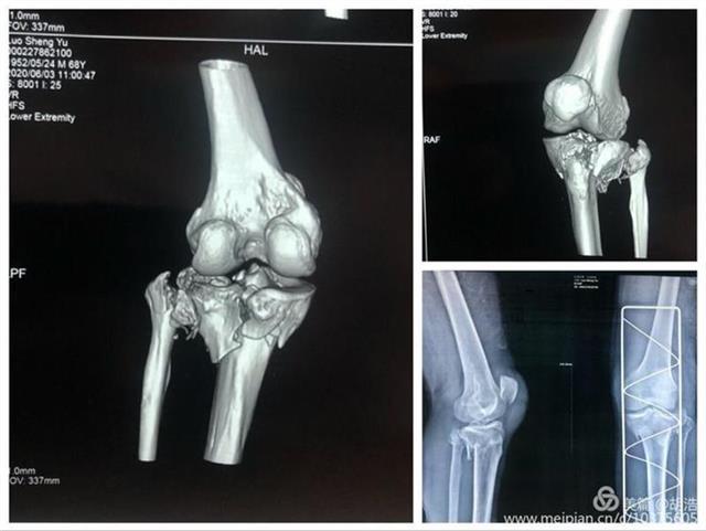 协和江南医院利用3d打印技术 成功为胫骨骨折患者实施手术 腾讯新闻