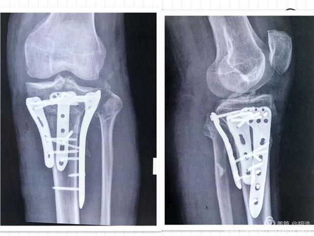 协和江南医院利用3d打印技术 成功为胫骨骨折患者实施手术 腾讯新闻