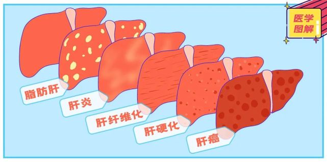 瘦子怎麼來的脂肪肝?其實除了脂肪,肝還怕這個!