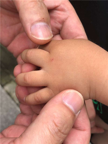 女童豆豆被猫抓伤的痕迹.