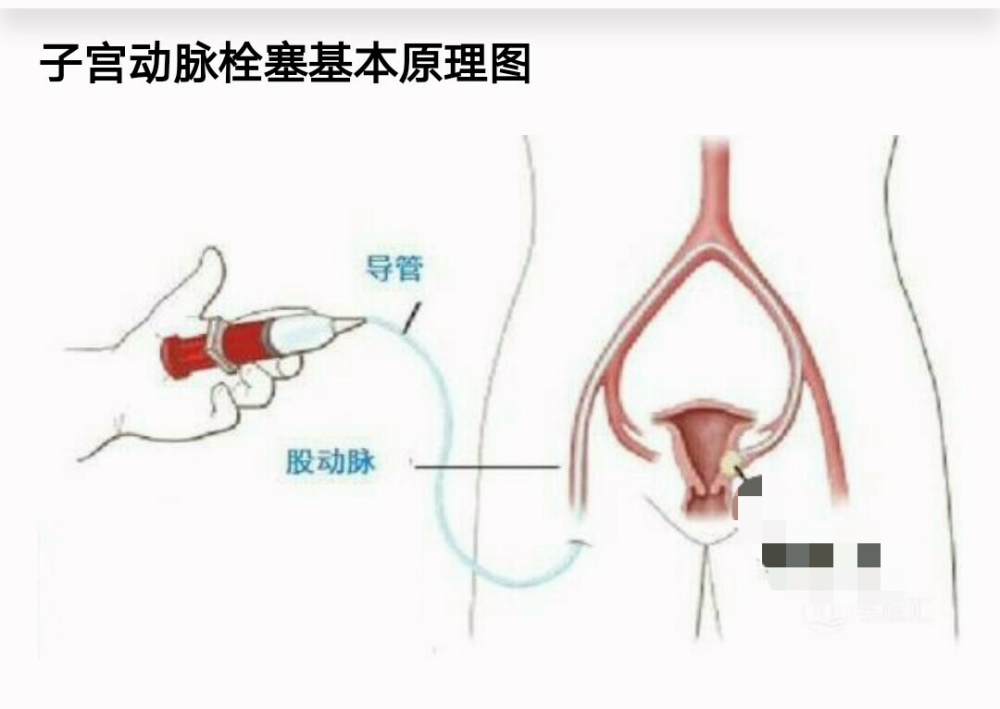 子宮動脈栓塞介入治療屬於血管介入性手術,利用現代醫學影像導向技術