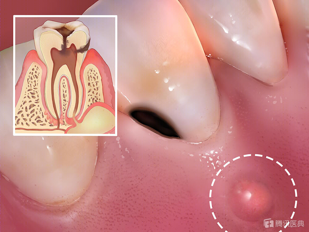 牙龈肿痛流脓你可能得了根尖周脓肿会对牙齿造成这3大影响尽早治疗