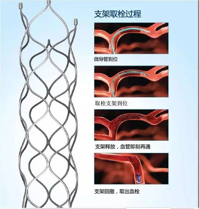 卒中团队积极开展急诊动脉溶栓,动静脉联合溶栓以及支架取栓术等