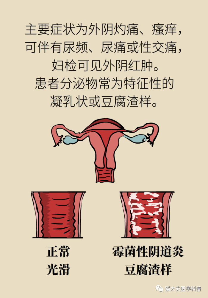 霉菌性阴道炎手把手教你抗霉大法