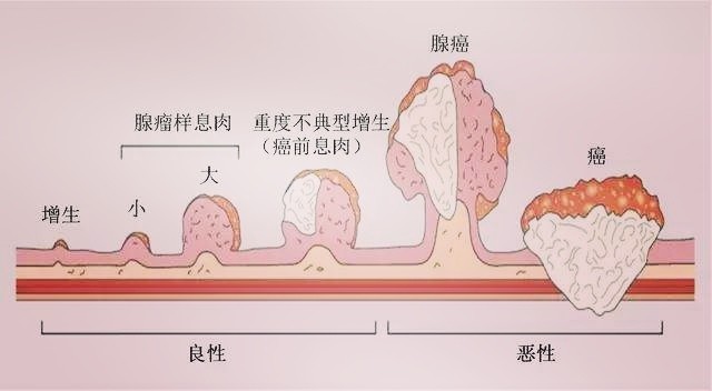 肠癌的演变过程图片图片