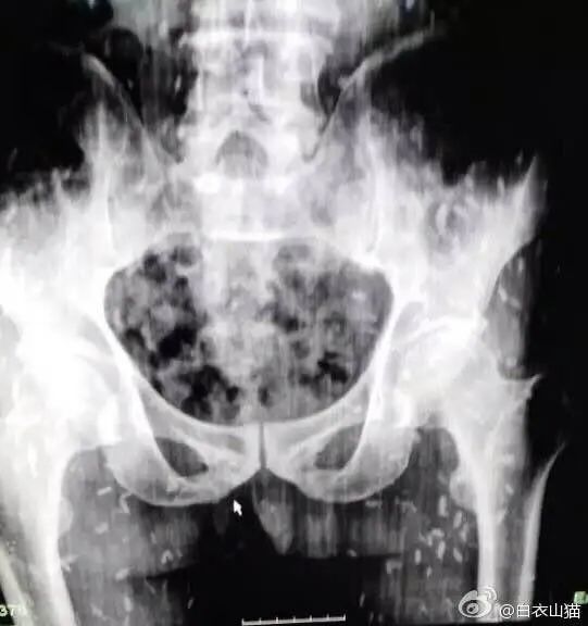 拍了x光片后,也可以看到密集的钙化的死亡的猪肉绦虫囊尾蚴