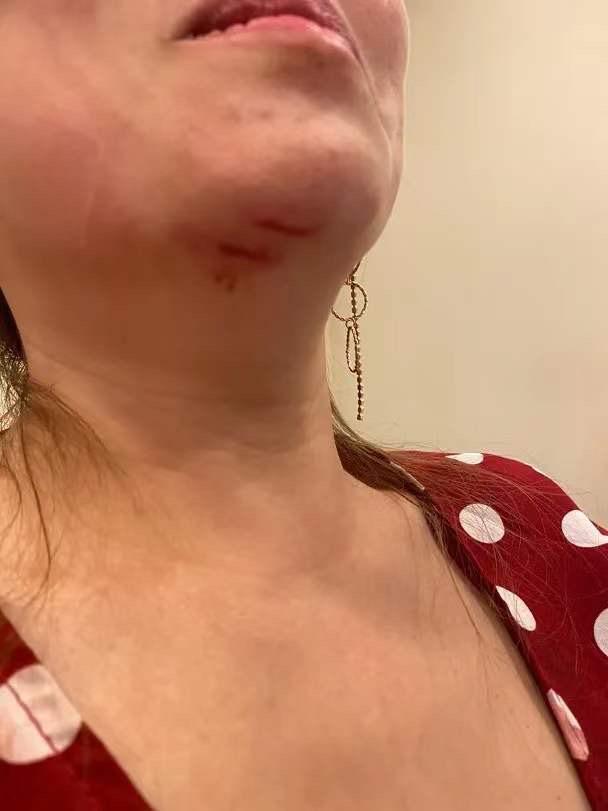 夜店遇袭 香港女歌手被外国女连踢数脚 下巴缝十针衣服血迹斑斑 腾讯新闻