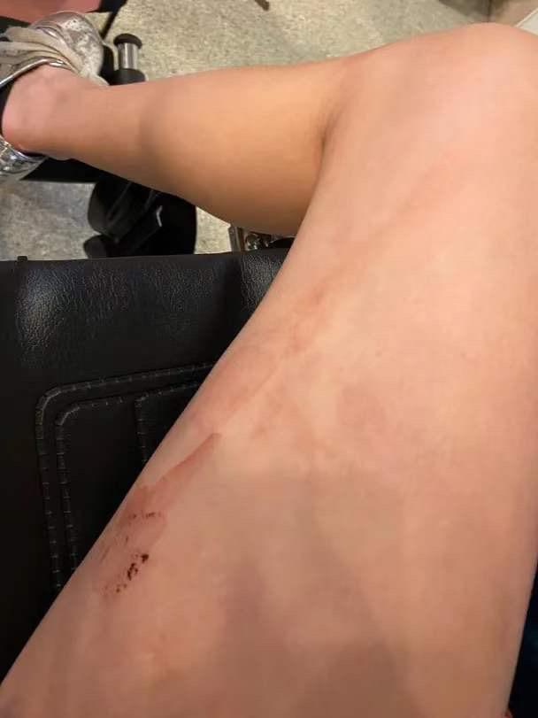 夜店遇袭 香港女歌手被外国女连踢数脚 下巴缝十针衣服血迹斑斑 腾讯新闻