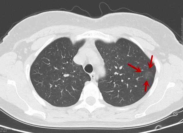 肺癌早期症状ct图片图片