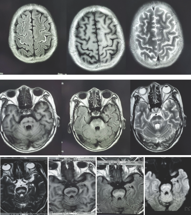 Mog抗体视神经炎 渗透性髓鞘溶解综合征 多系统萎缩 腾讯网
