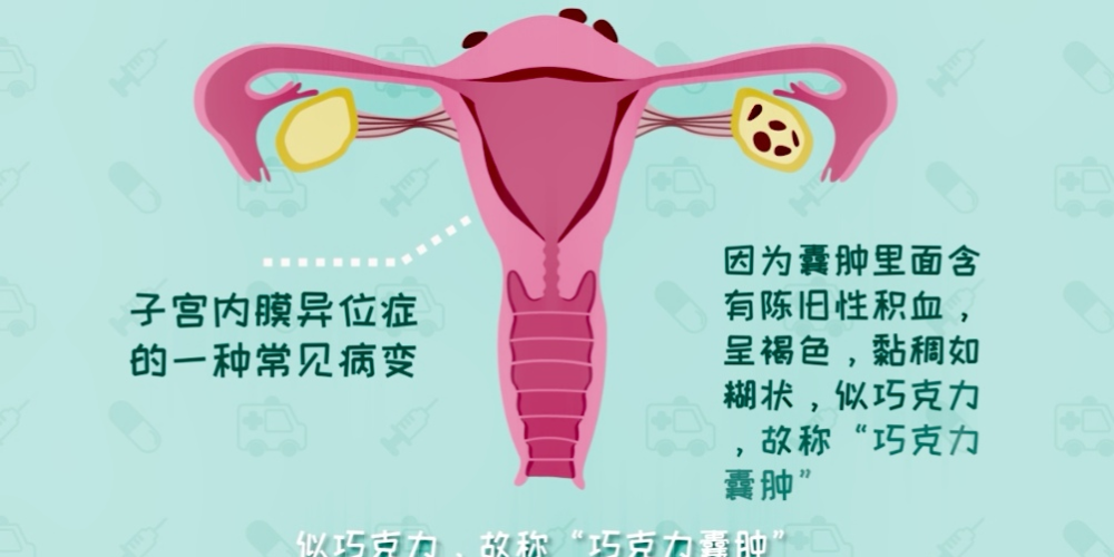 卵巢巧克力囊肿治疗1巧囊大于六公分的,建议手术,单纯的药物治疗在