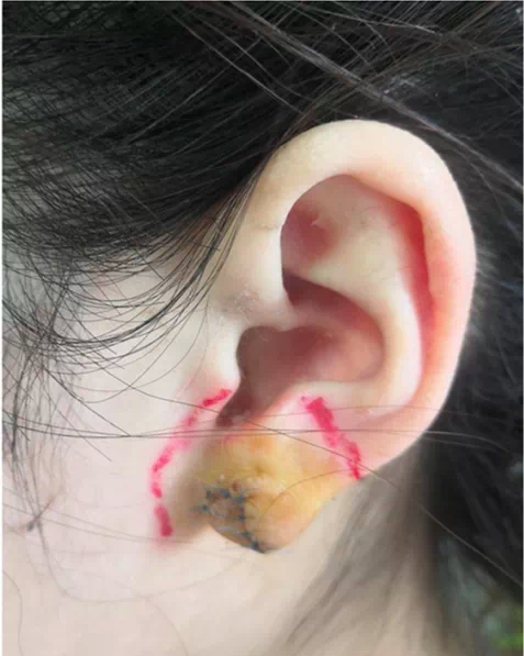 "小耳洞"长出"大耳垂",警惕美丽的"代价"_腾讯新闻