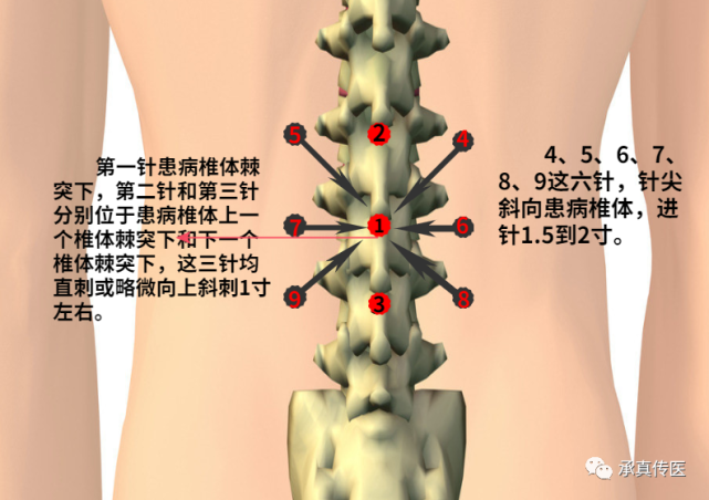 九宫穴治疗脊椎病变效果好