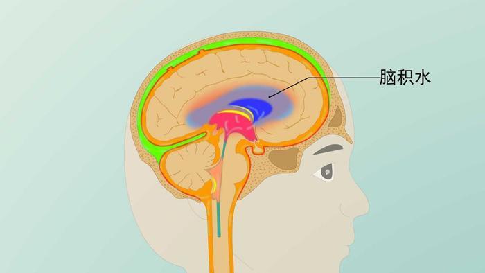 有些患者在拍ct时意外检查出有脑积水,不知道怎么回事?该怎么办?