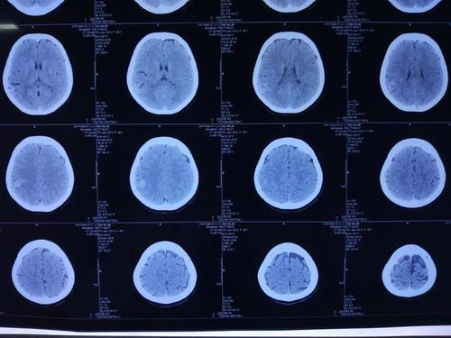 研究需要生物标志物来支持额颞叶变性的诊断