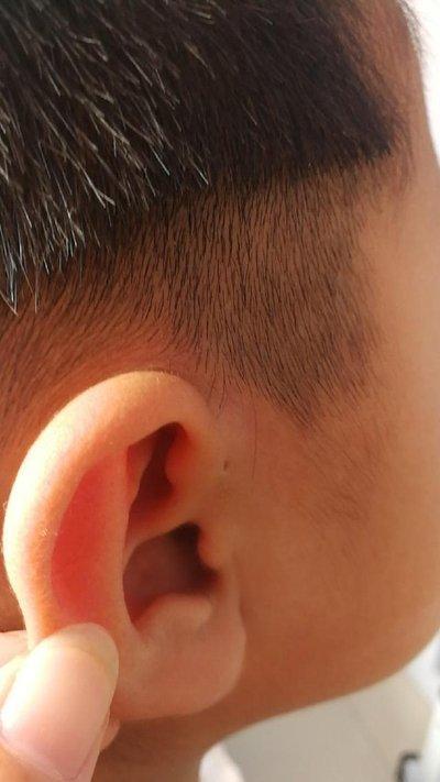 为什么有些婴儿天生耳朵有"小孔"?医生不说,父母自己要知道