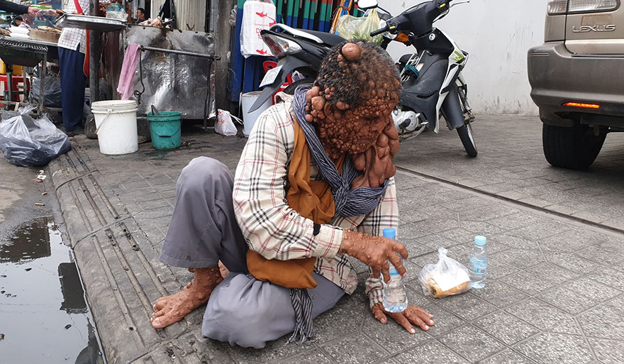 柬埔寨一老人得了怪病,每日只能在市场乞讨要饭维持生活