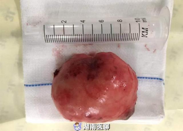 女子耳后鼓了一个包,不痛也不痒,检查一看竟是肿瘤"在惹祸"