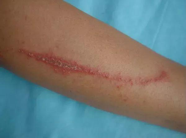 孩子随手拍死小虫,第二天满手脓疱,夏天遇到这种虫子一定当心