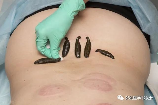 中药水蛭性味归经及临床运用发现