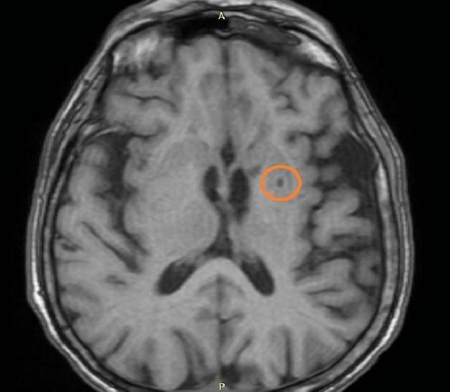 总咬舌头 是5种疾病预兆 家有老人的一定要看看 舌头 腔隙性脑梗死 老人 舌癌 牙齿 垂体瘤