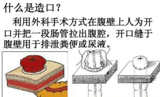 11岁男孩腹腔巨大脓肿,术中吸出脓液竟高达2000ml