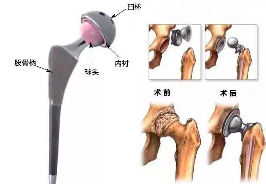 而半髋是指仅仅置换股骨一侧,也就是说,半髋只有球头和股骨柄,没有