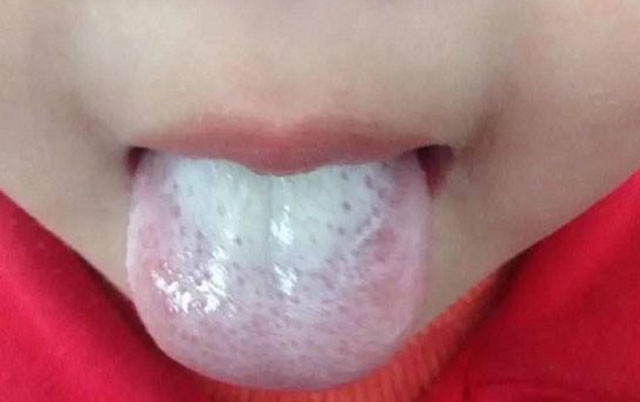 也不难发现舌苔比较厚而且比较白,如果积食严重的话,还可能舌苔发黄