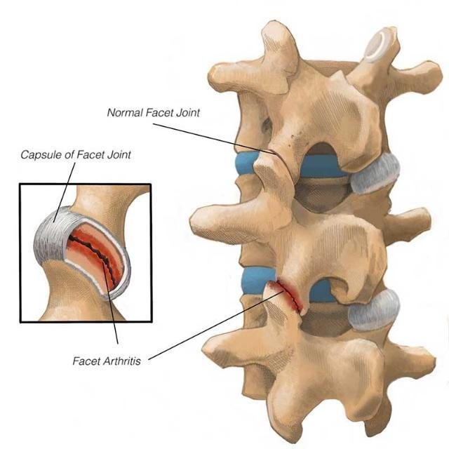 颈椎关节突交锁图片