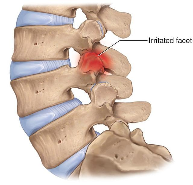 导致的腰椎小关节承受的压力过大,造成的小关节骨关节炎也是原因之一