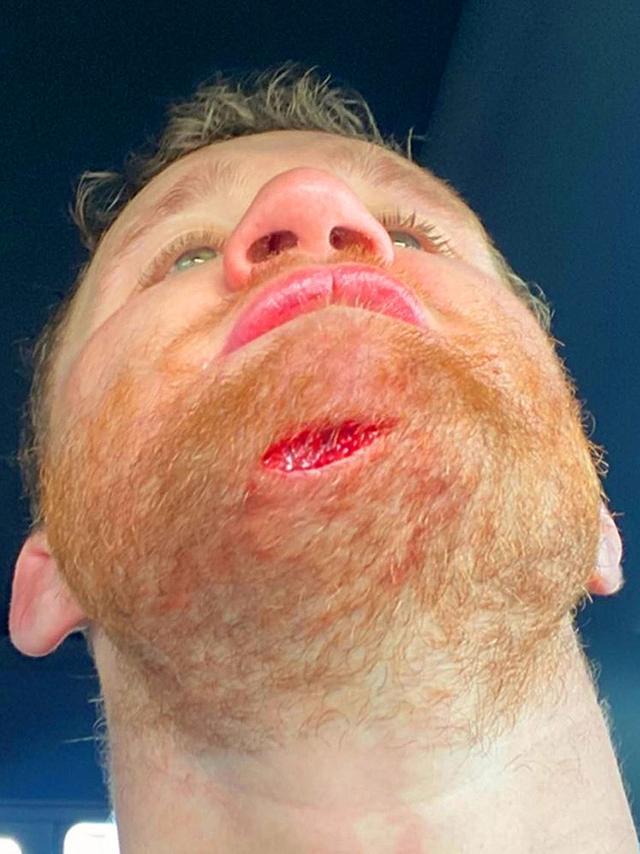 平头哥训练被撞两英寸深伤口劝嘴炮别退役我找到揍你的方法了