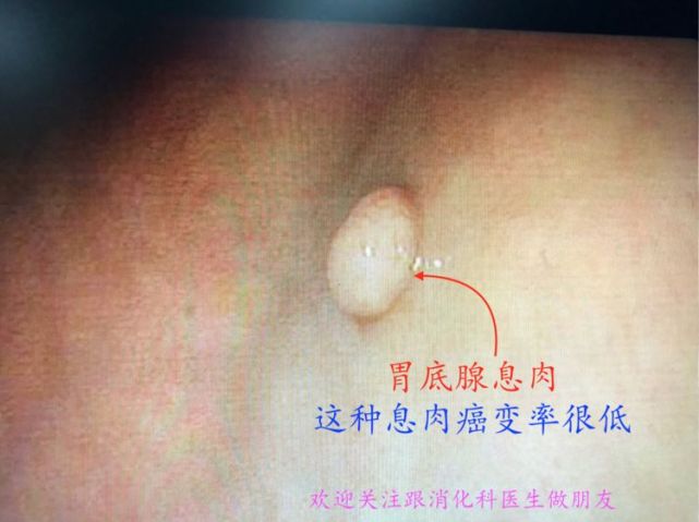 关于肠道息肉切除后将来如何预防胃肠道息肉复发我会在本专栏