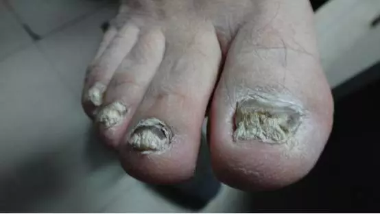 灰指甲怎么治之外用阿莫罗芬