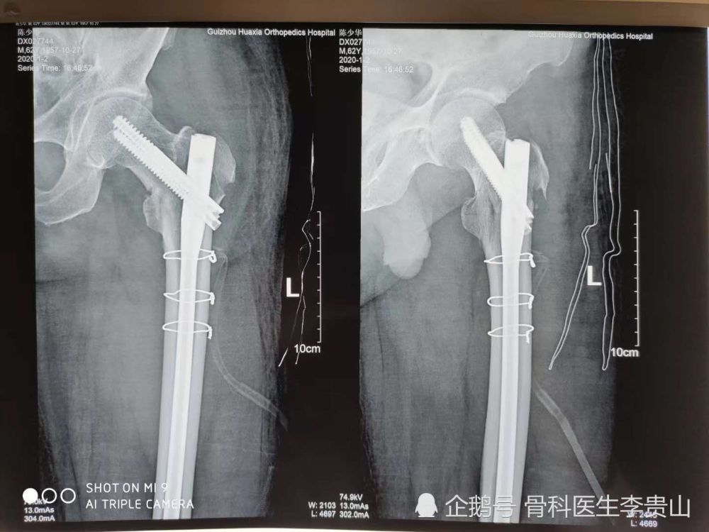 有贵阳的粉丝私信我 骨折手术什么时候做最合适 腾讯新闻