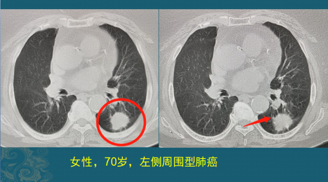 肺癌3cm 该花钱动手术 还是游山玩水开心每一天 癌症 咳嗽 肺癌 肿瘤