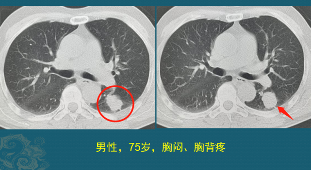 女性,不吸烟,鳞癌极少见,所以这个病灶符合周围型肺腺癌的特点,影像
