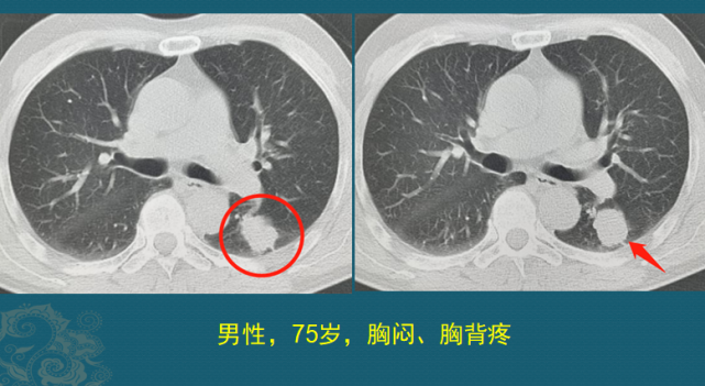 肺癌3cm 该花钱动手术 还是游山玩水开心每一天 癌症 咳嗽 肺癌 肿瘤