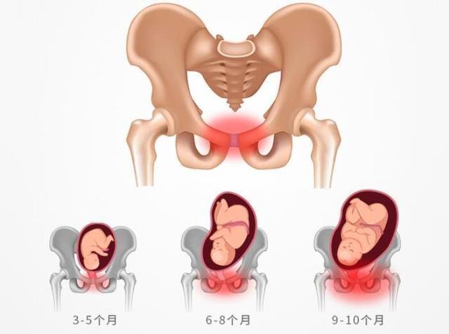 孕晚期最难熬的 耻骨痛 5类孕妈要注意 千万别被找上门 腾讯网