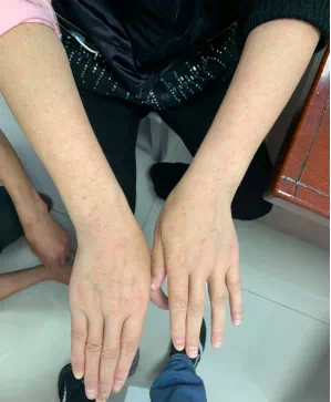 无故起了红色疹子是服药过敏吗?都是基因"惹的祸"!