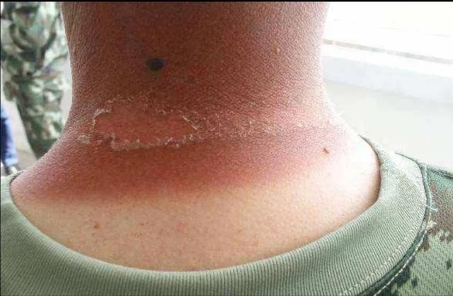 03 日照性皮炎易罹患皮肤病和血吸虫病浸入浑浊不清的湍流洪水养成