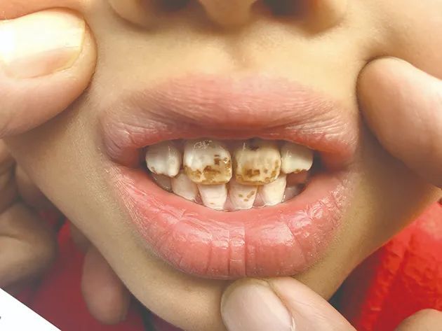 健康陕西地方性氟中毒防治知识