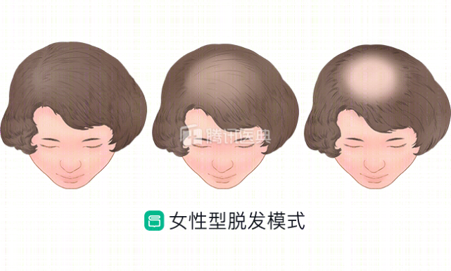 秃发会遗传给孩子？有遗传倾向，但非绝对！这3点也是导致脱发的罪魁祸首_腾讯新闻