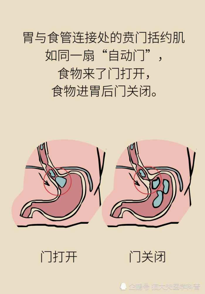 胃食管反流|胃食管反流很烧心，预防要做好这三方面