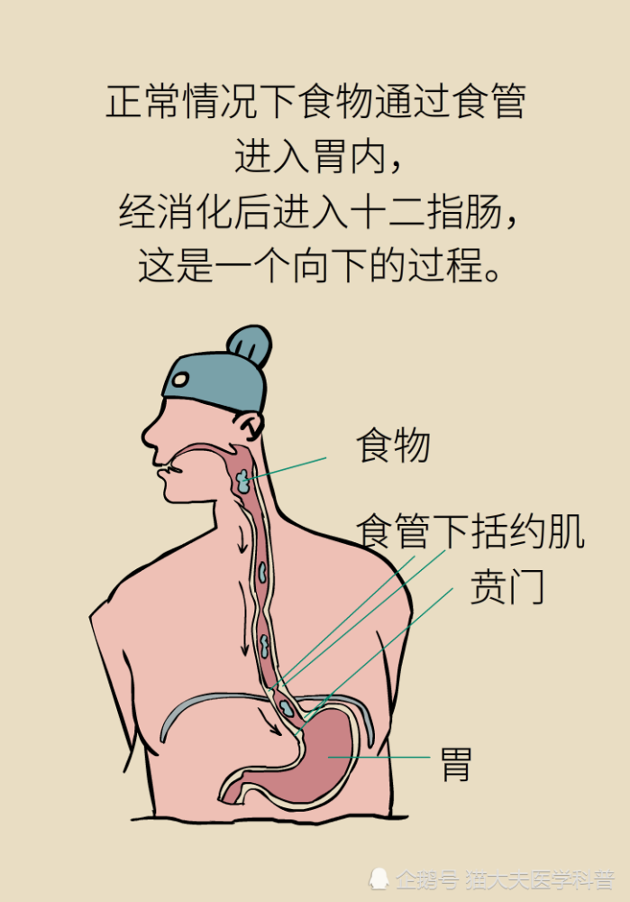 胃食管反流|胃食管反流很烧心，预防要做好这三方面