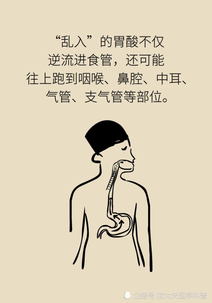 胃食管反流|胃食管反流很烧心，预防要做好这三方面