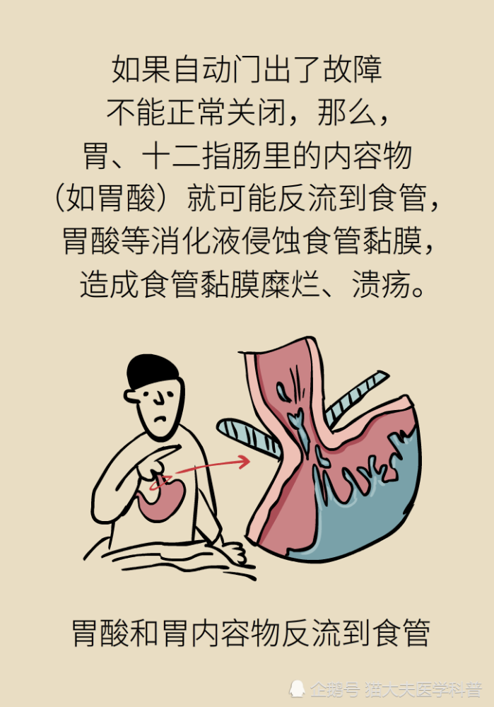 胃食管反流|胃食管反流很烧心，预防要做好这三方面
