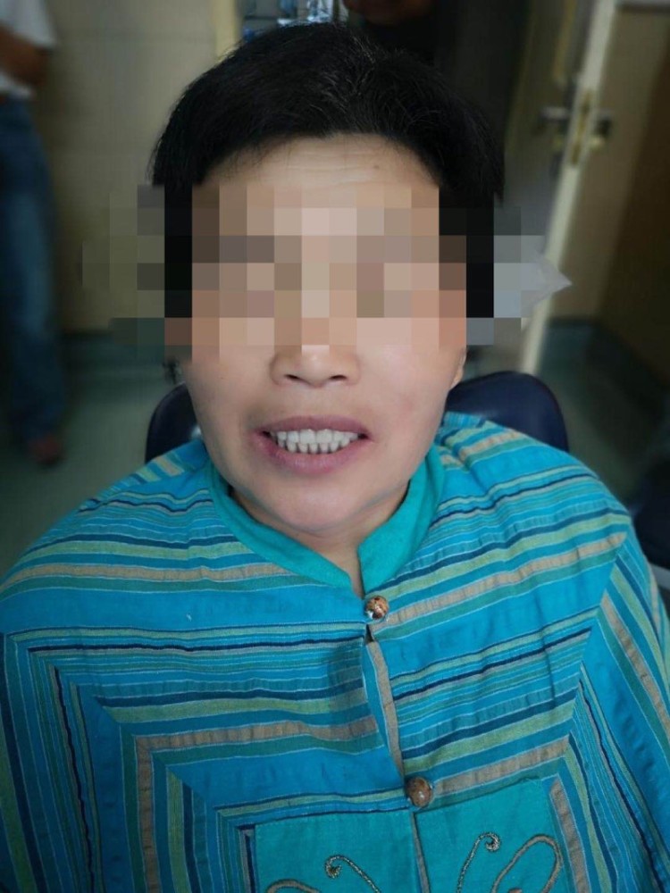 63岁老人多半牙齿已掉光竟然又长出了人生第三副牙齿